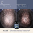 Before and after comparison of hair thickness with Votesse supplement bottle shown.
